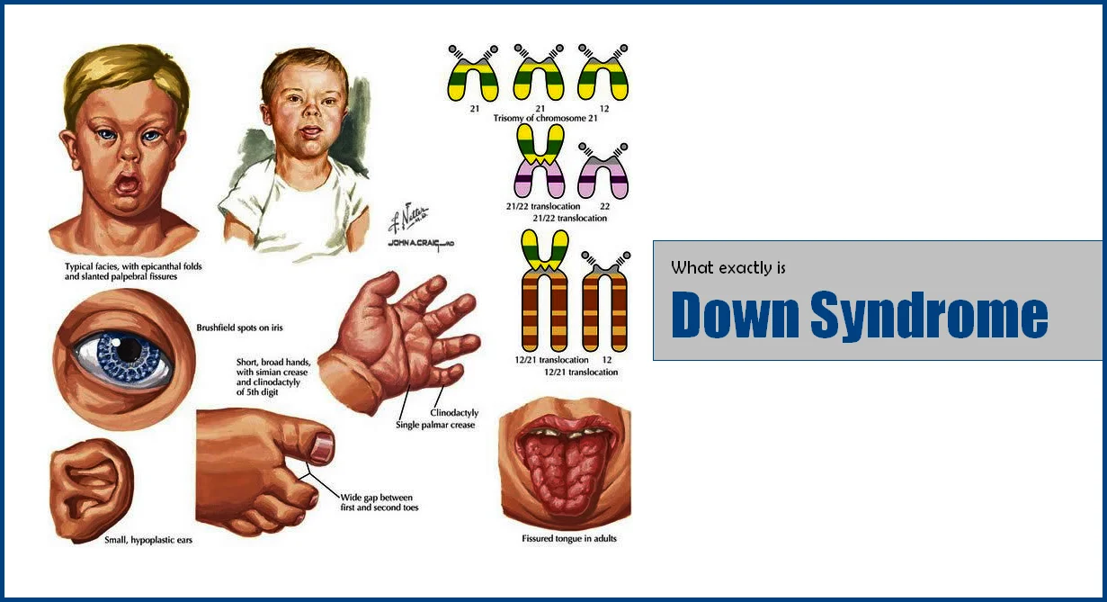 Down Syndrome : It is a Genetic Disorder of Humans 2024